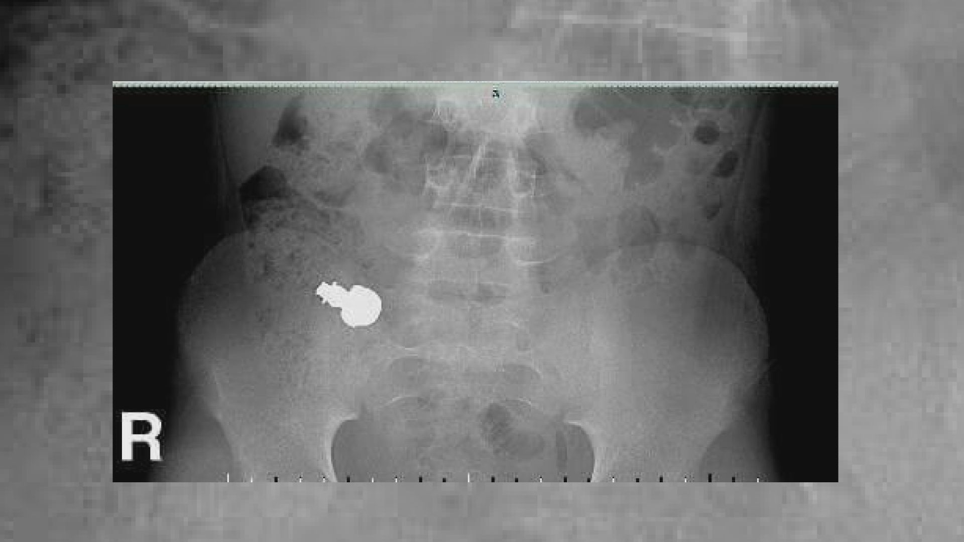 Frosty The Snowman Captured In Boy's XRay